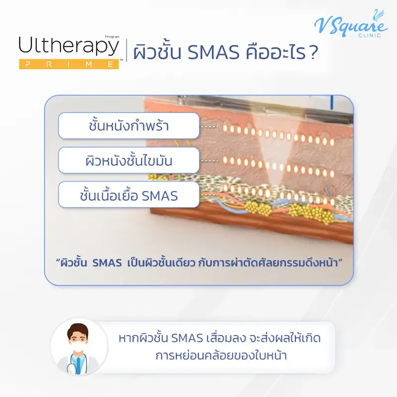 รีวิวหลักการทำงาน Ulthera