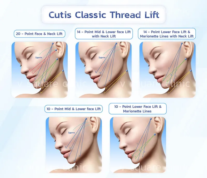 ร้อยไหม ยกร่องแก้มลึก ร้อยไหม ยกร่องแก้มลึก