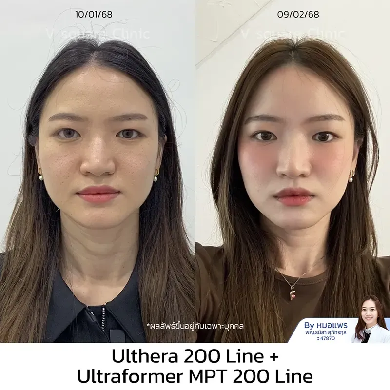 รีวิว Ulthera ทั่วหน้า_ฟิว
