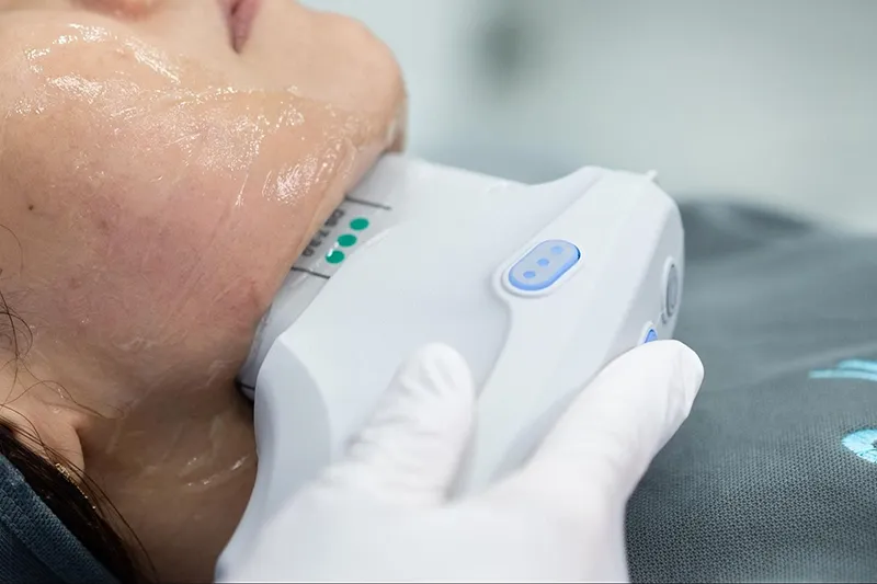 ราคาทำ Ulthera Prime ทั่วหน้า+ลำคอ