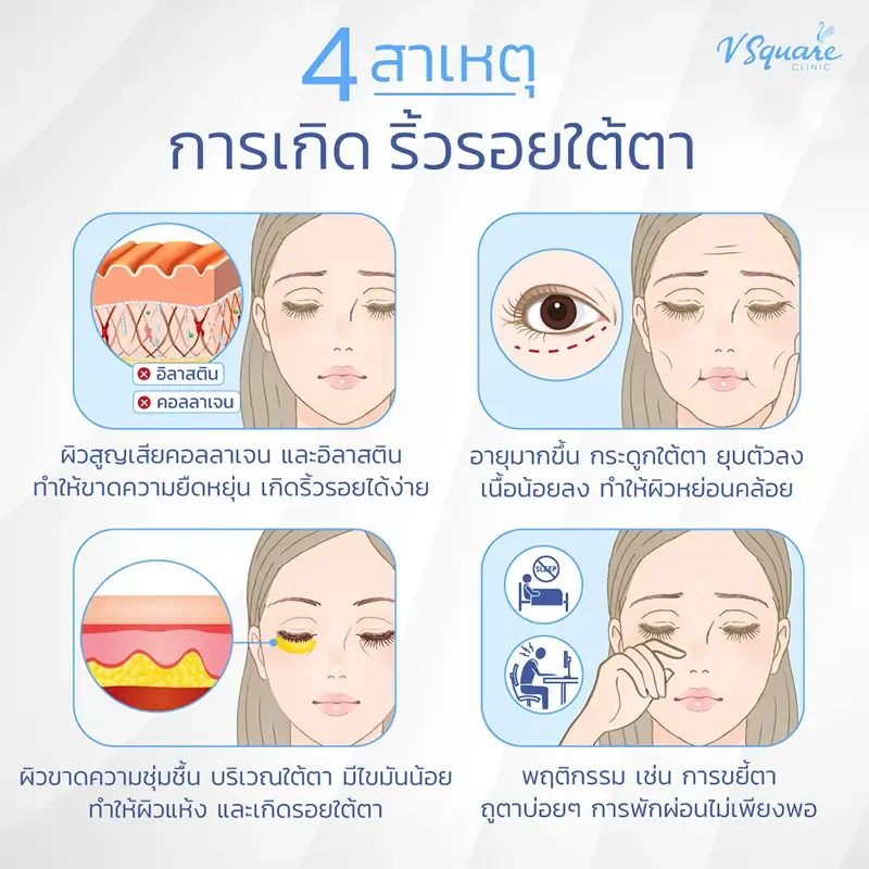 ริ้วรอยใต้ตา เกิดจาก