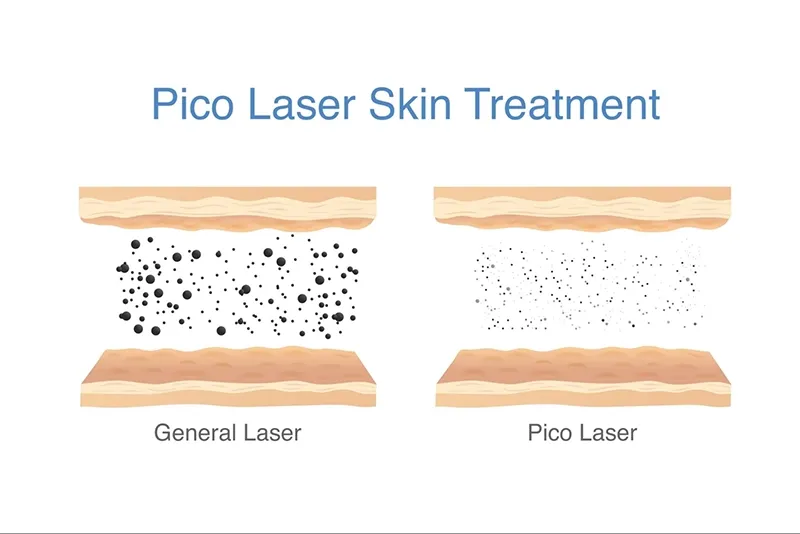 Pico Laser คืออะไร
