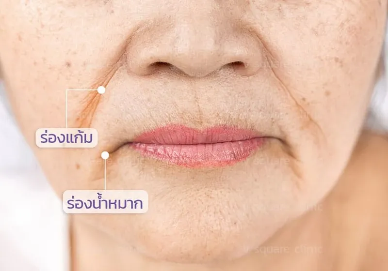 ร่องแก้มลึก กับ ร่องน้ำหมาก ต่างกันอย่างไร ร่องแก้มลึก กับ ร่องน้ำหมาก ต่างกันอย่างไร