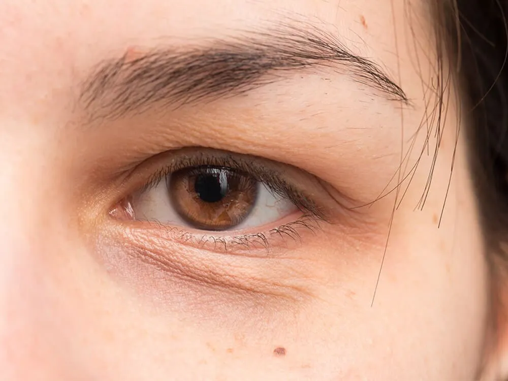 ปัญหาใต้ตาที่แก้ไขได้ด้วยฟิลเลอร์ใต้ตา ปัญหาใต้ตาที่แก้ไขได้ด้วยฟิลเลอร์ใต้ตา