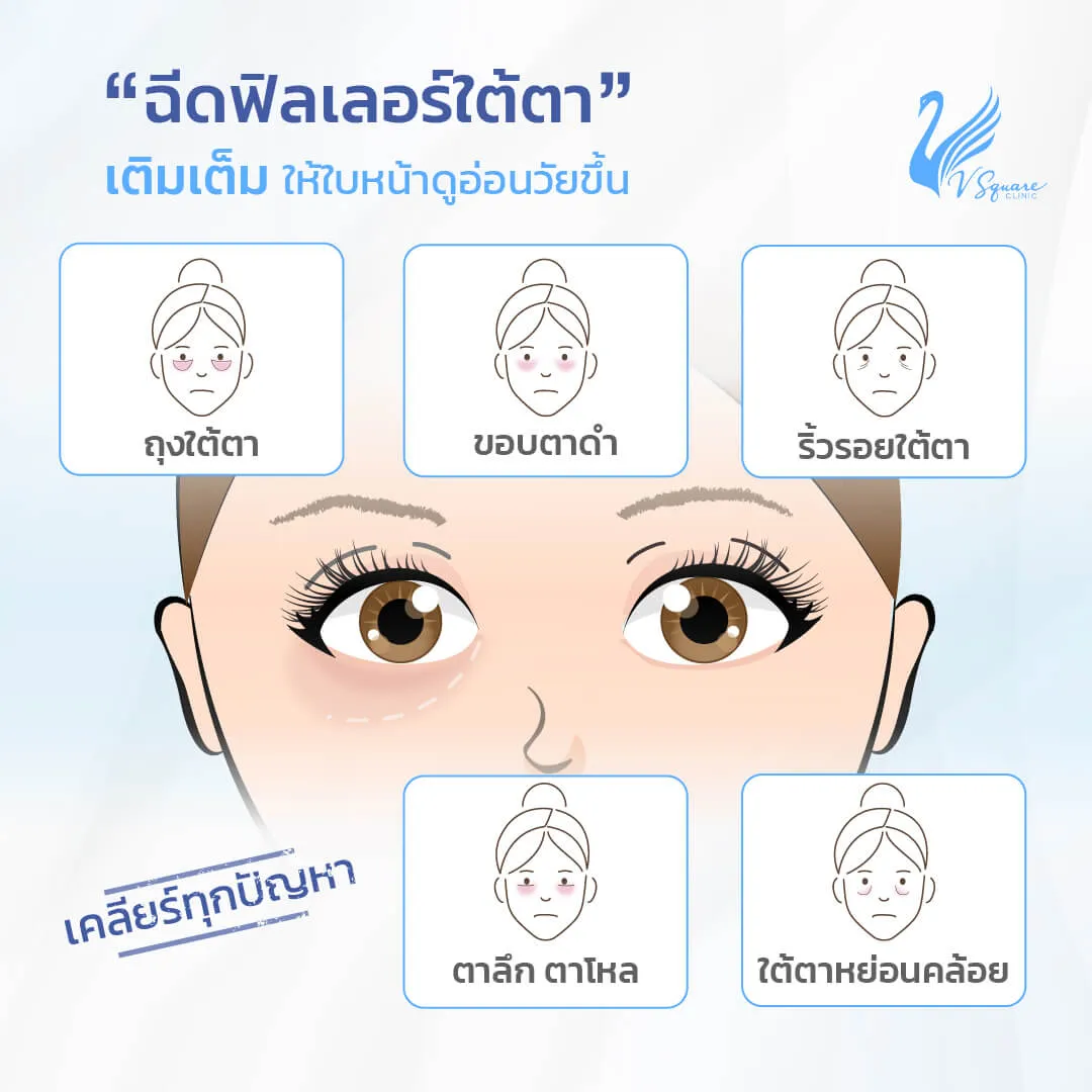 ฉีดฟิลเลอร์ใต้ตา ช่วยเรื่องอะไรบ้าง ฉีดฟิลเลอร์ใต้ตา ช่วยเรื่องอะไรบ้าง