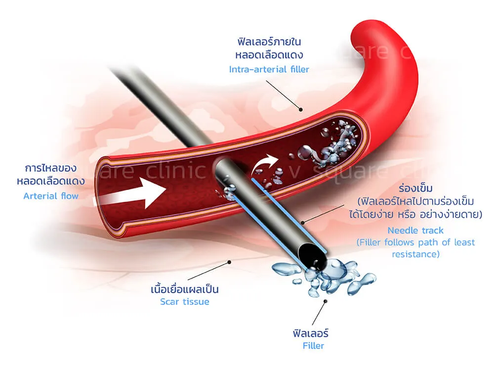 การฉีดฟิลเลอร์มใต้ตา ต้องระวังไม่ให้เข็มแทงเข้าเส้นเลือด 