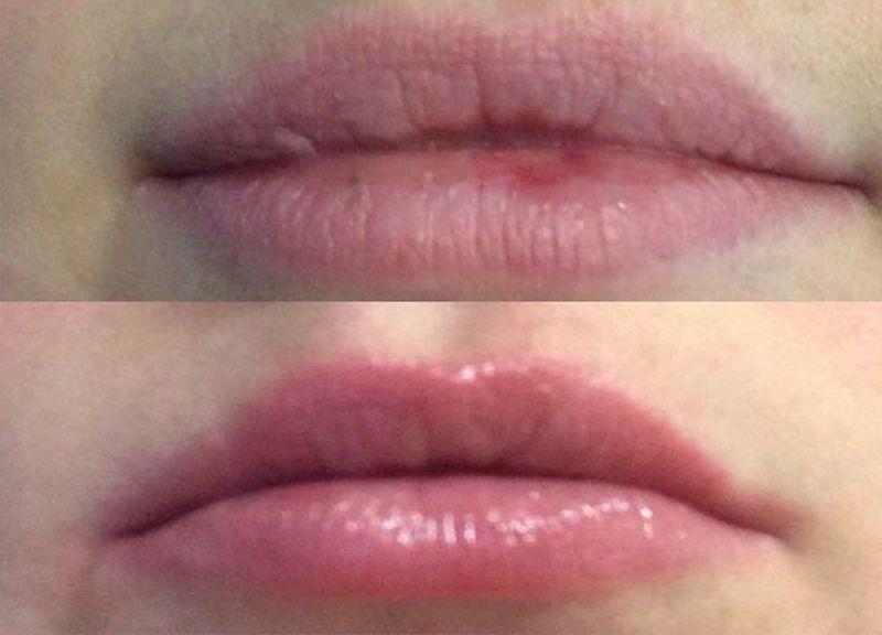 ปัญหาปากบาง ปากแห้ง แก้ไขด้วยฟิลเลอร์ปาก