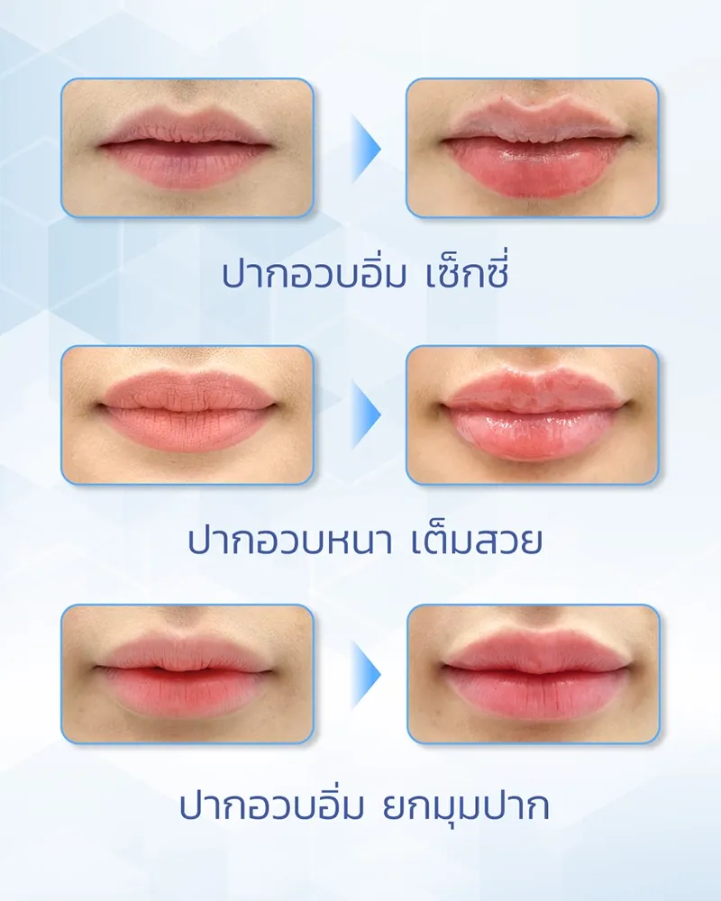 รู้จัก Restylane Kysse เติมปากอวบอิ่ม ขอบปากชัด ปรับสีปากสดใส รู้จัก Restylane Kysse เติมปากอวบอิ่ม ขอบปากชัด ปรับสีปากสดใส