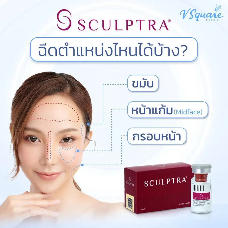 ฉีด Sculptra หน้าเด็ก ผิวอ่อนเยาว์เป็นธรรมชาติ อยู่ได้นานไหม ? ฉีด Sculptra หน้าเด็ก ผิวอ่อนเยาว์เป็นธรรมชาติ อยู่ได้นานไหม ?
