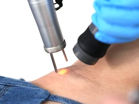 เลเซอร์รักแร้ขาว ลดความหมองคล้ำ เผยผิวใต้วงแขนกระจ่างใส เลเซอร์รักแร้ขาว ลดความหมองคล้ำ เผยผิวใต้วงแขนกระจ่างใส